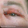 Blepharoplasty-side-effects03.jpg Blepharoplasty-side-effects03.jpg