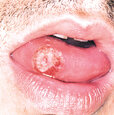 syphilis-1-oral.jpg