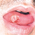 syphilis-1-oral.jpg syphilis-1-oral.jpg