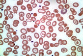 Hemoglobin-H-Disease.jpg