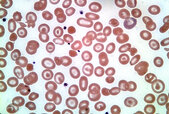 Hemoglobin-H-Disease.jpg Hemoglobin-H-Disease.jpg