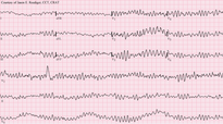Ventricular_fibrillation.png Ventricular_fibrillation.png