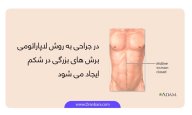 لاپاراتومی-vs-لاپاراسکوپی.jpg لاپاراتومی-vs-لاپاراسکوپی.jpg